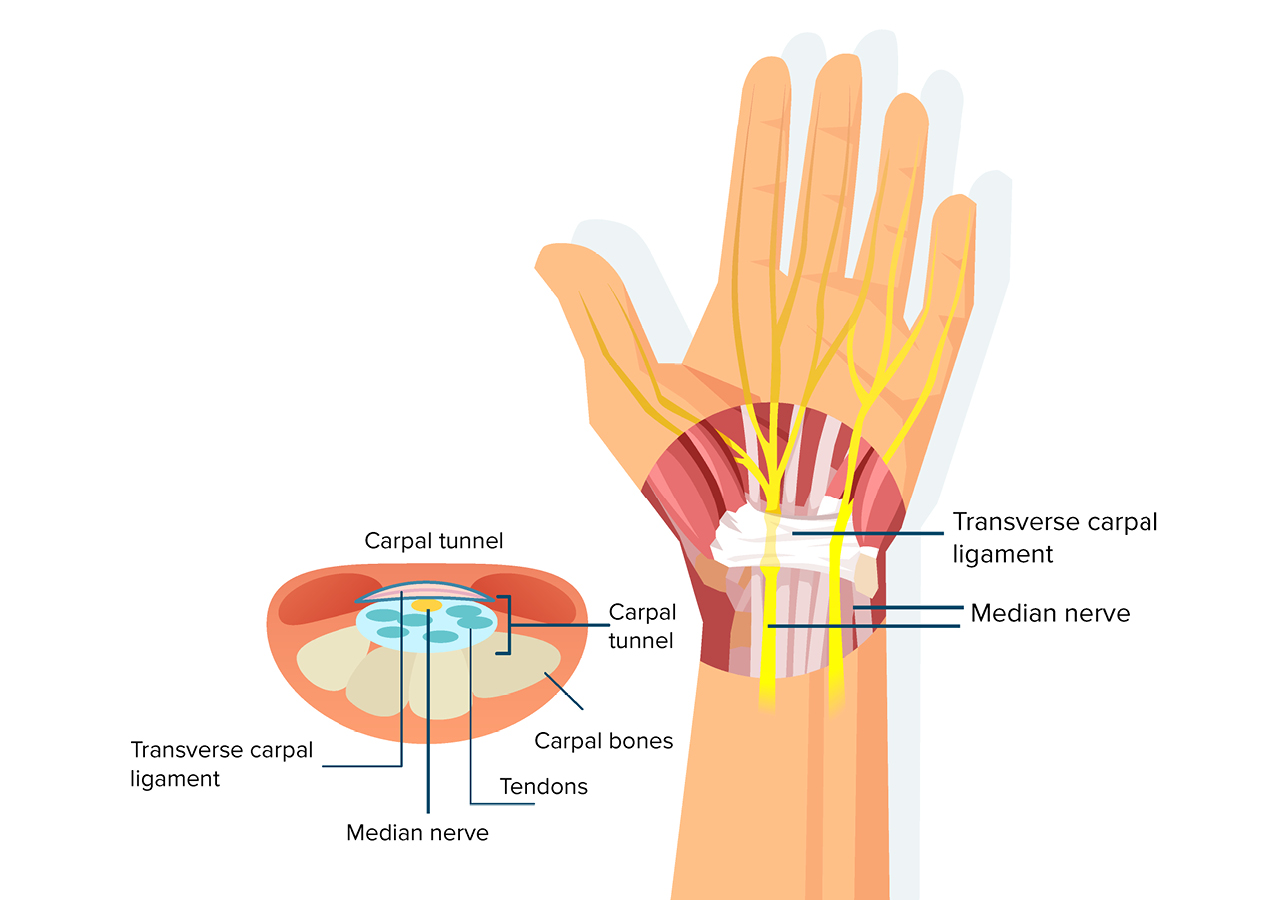 Carpal tunnel syndrome | Posturite